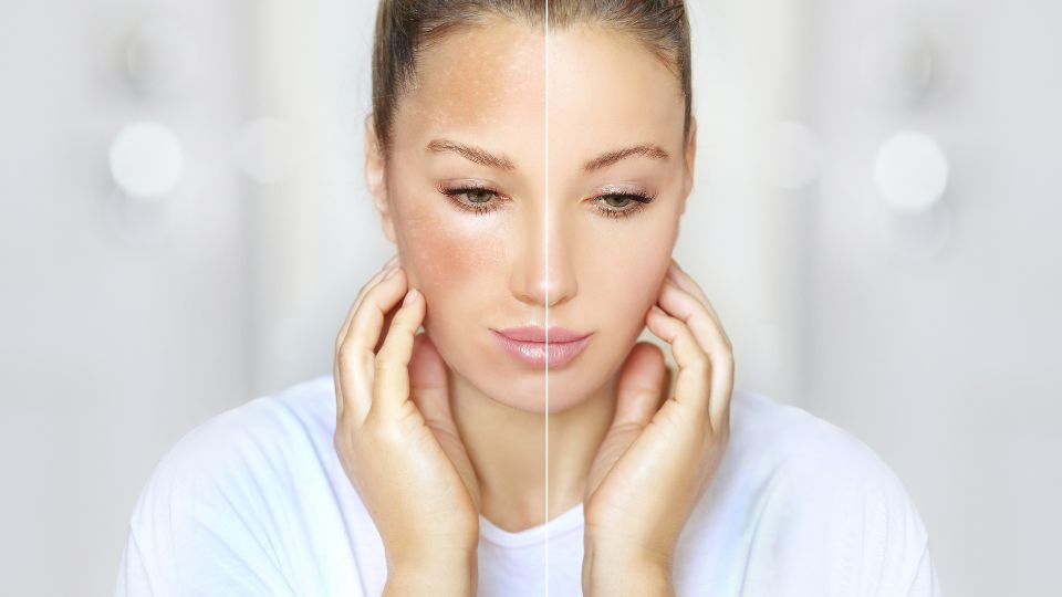 Crema anti-pigmentare